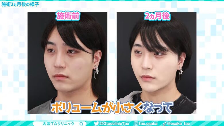 エラ周辺のボリュームが減りシャープになった2カ月後の比較画像