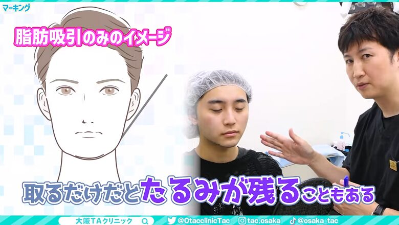 脂肪吸引のみの場合のたるみリスクの解説図