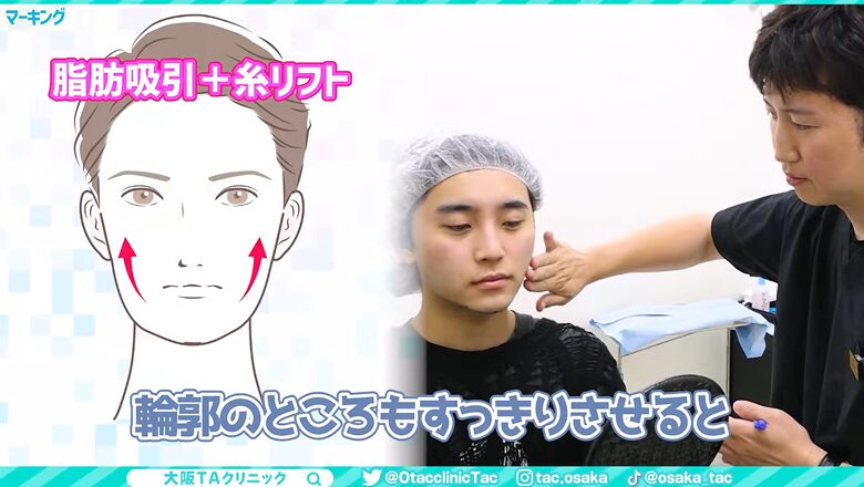 脂肪吸引と糸リフトの併用による引き上げ効果を示すイメージ図
