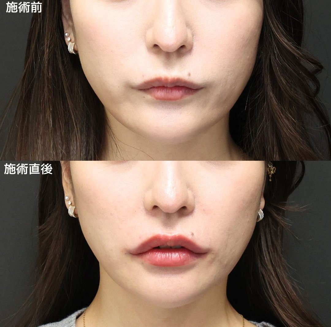 《唇ヒアル》で作るモテリップ×人中短縮