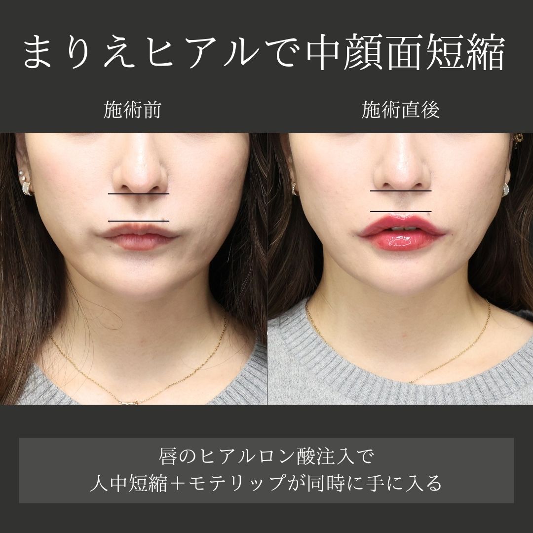 ヒアルロン酸注射：その他の症例写真 施術前後 