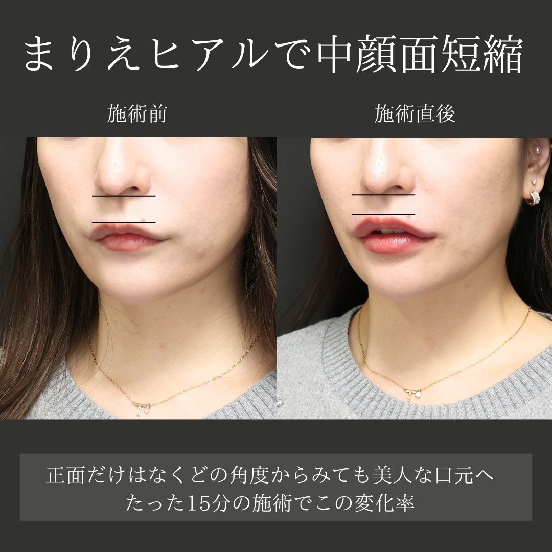 ヒアルロン酸注射：その他の症例写真 施術前後 