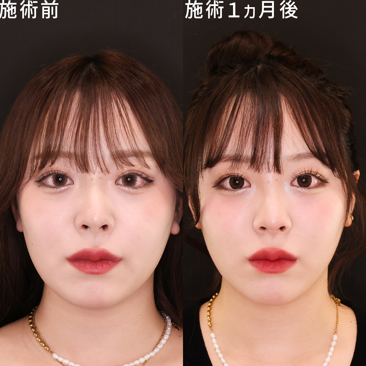 脂肪除去×糸リフト！あなただけの小顔整形で自然な変化を