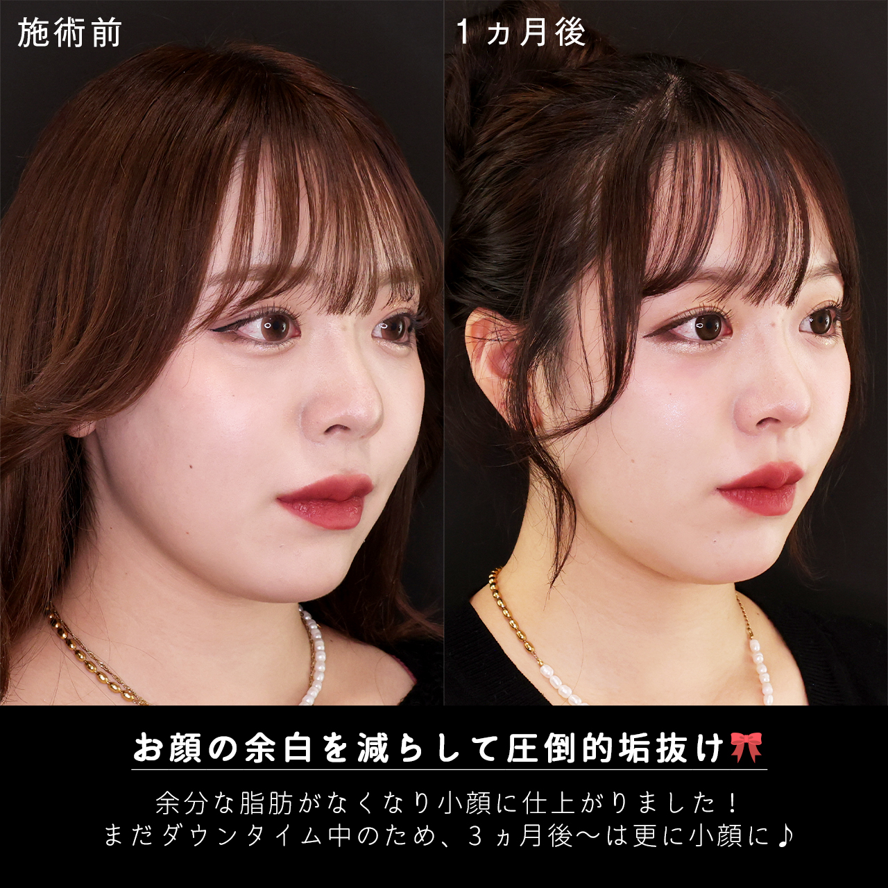 TAC式 ツヤ肌コラーゲンリフト®/Lラインファット除去（エラ下脂肪除去）/ジョールファット除去の症例写真 施術前後 