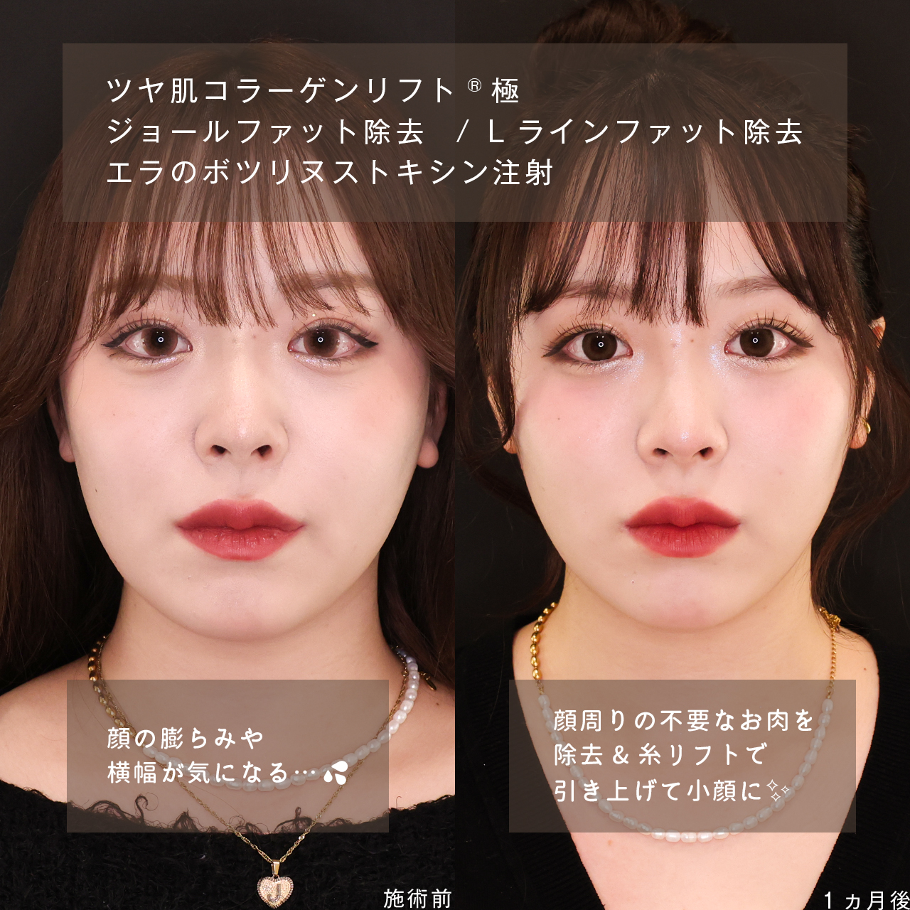TAC式 ツヤ肌コラーゲンリフト®/Lラインファット除去（エラ下脂肪除去）/ジョールファット除去の症例写真 施術前後 