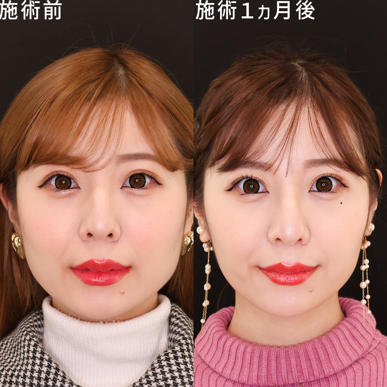 TAC式 ツヤ肌コラーゲンリフト®/ジョールファット除去/エラボトックス注射の症例写真 施術前後