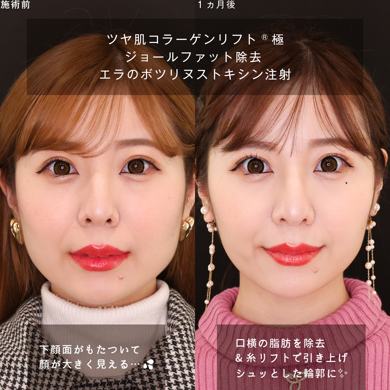 TAC式 ツヤ肌コラーゲンリフト®/ジョールファット除去/エラボトックス注射の症例写真 施術前後