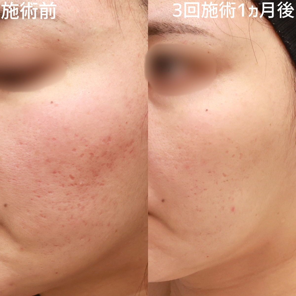 ヴァンパイアフェイシャル/ダーマペン4/エクソソーム/ベルベットスキンの症例写真 施術前後 