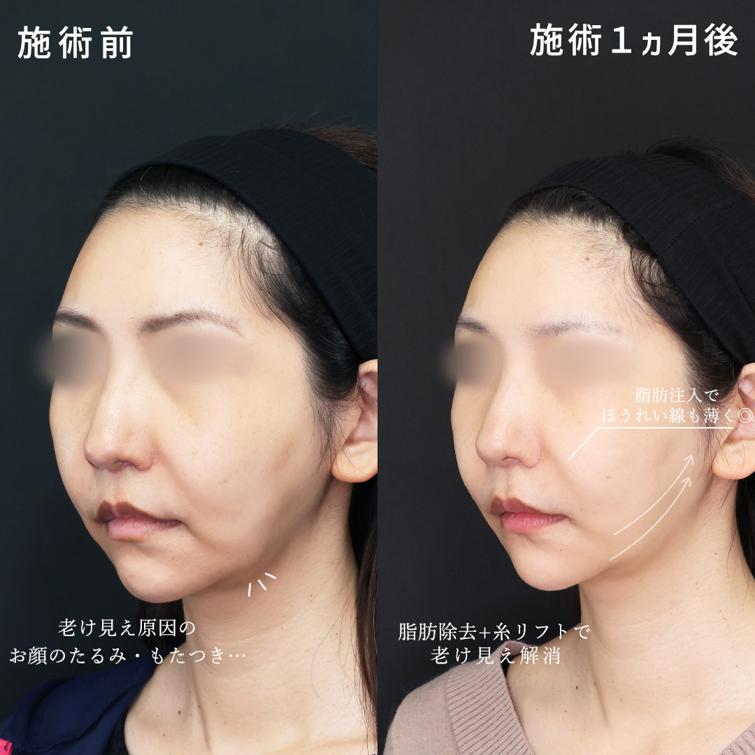 TAC式 ツヤ肌コラーゲンリフト®/TAC式 ショッピングリフト/ジョールファット除去の症例写真 施術前後 