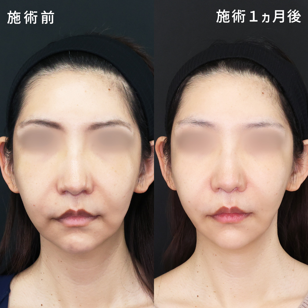 TAC式 ツヤ肌コラーゲンリフト®/TAC式 ショッピングリフト/ジョールファット除去の症例写真 施術前後 