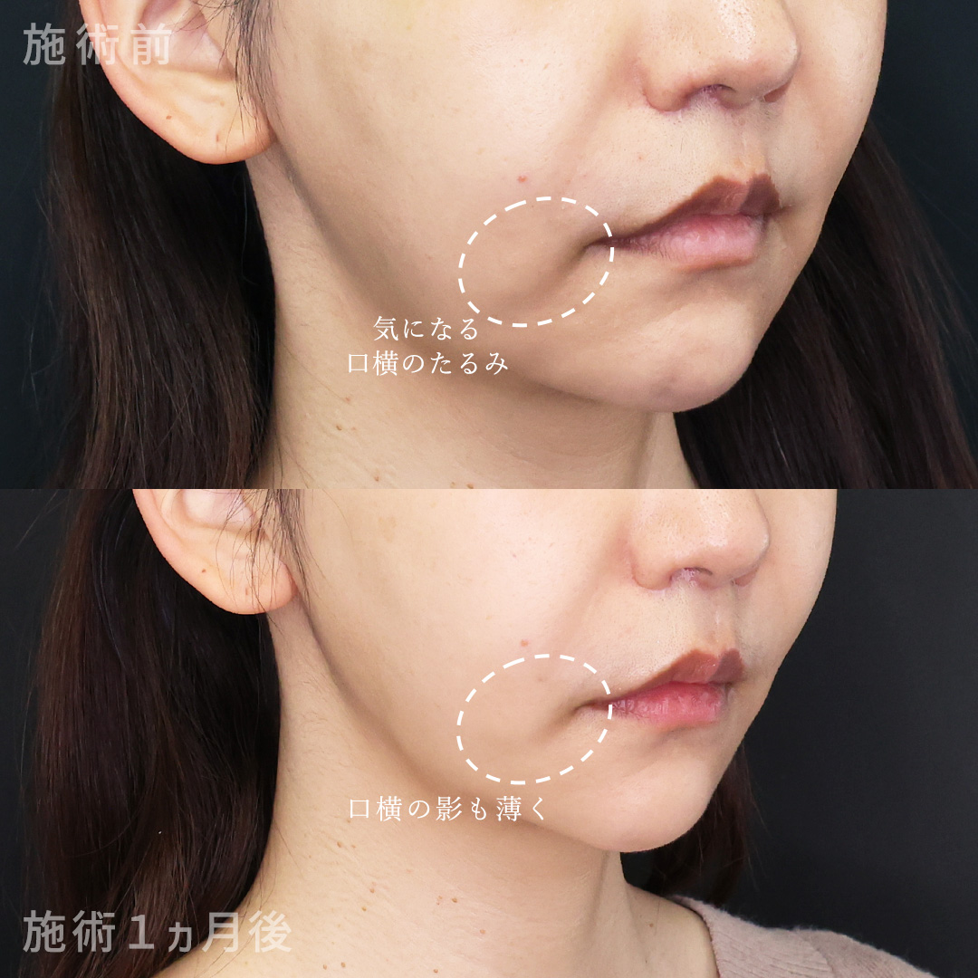 TAC式 ツヤ肌コラーゲンリフト®/TAC式 ショッピングリフト/ジョールファット除去の症例写真 施術前後 