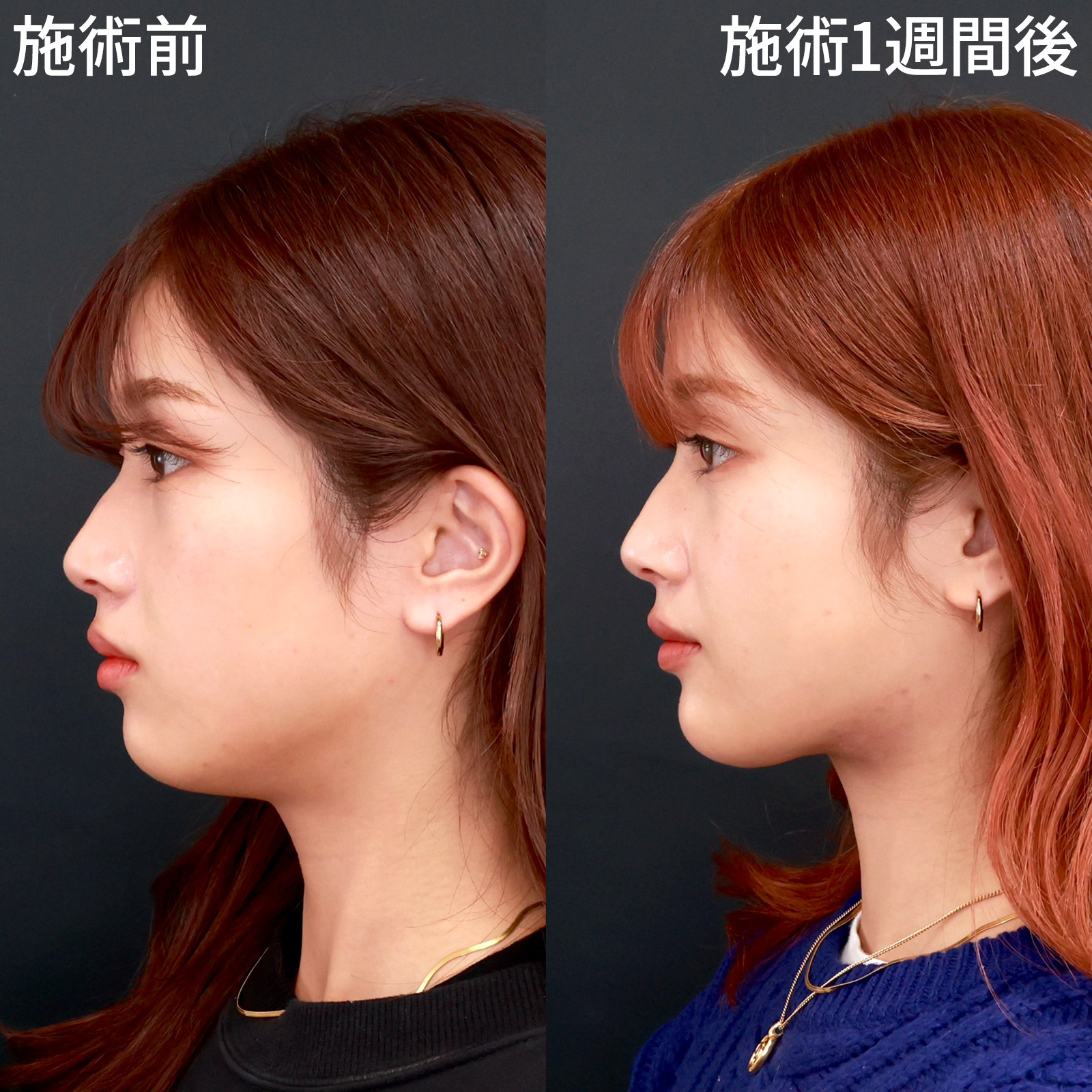 【顎下の脂肪吸引】たった1週間で、悩んでいた二重顎がスッキリ解消