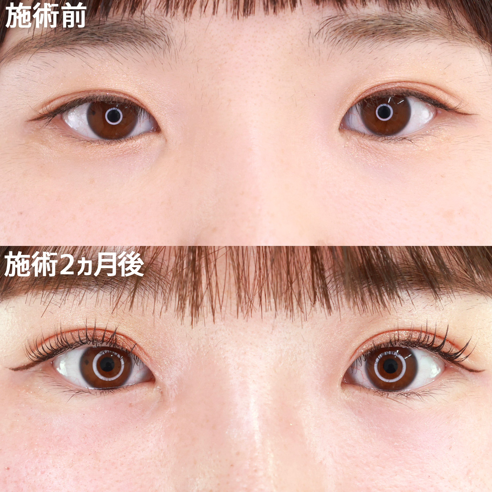 【二重埋没法】二重幅を少し広げつつ、左右差を改善！