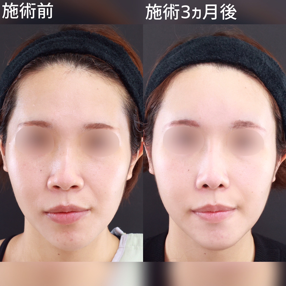 鼻尖形成・鼻尖縮小/鼻先軟骨移植/TAC式 鼻翼縮小術(小鼻縮小)の症例写真 施術前後