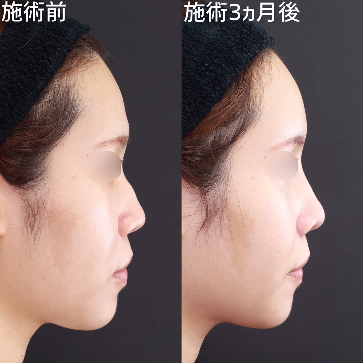 【S字ライン形成】女性らしい曲線で横顔美人