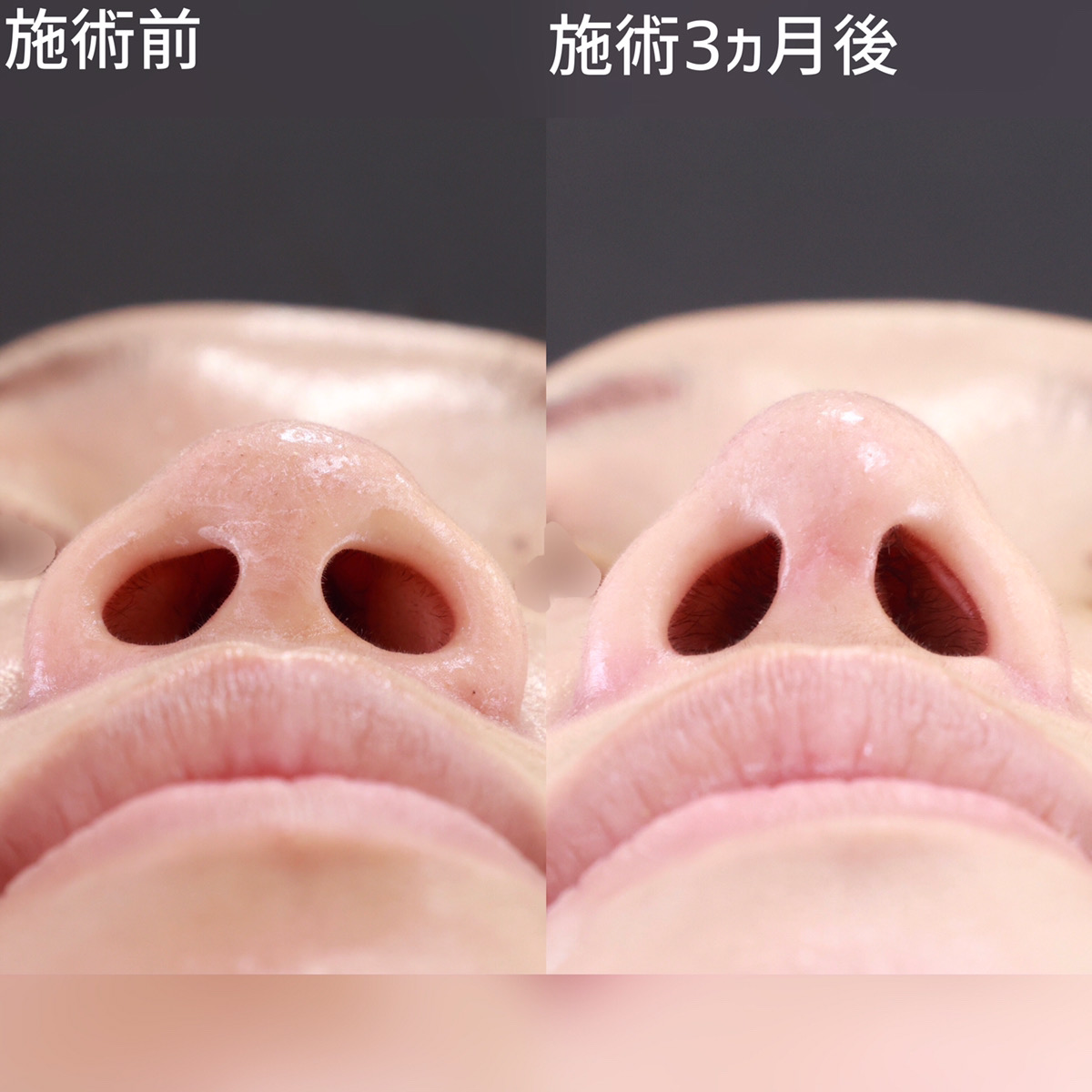 鼻尖形成・鼻尖縮小/鼻先軟骨移植/TAC式 鼻翼縮小術(小鼻縮小)の症例写真 施術前後
