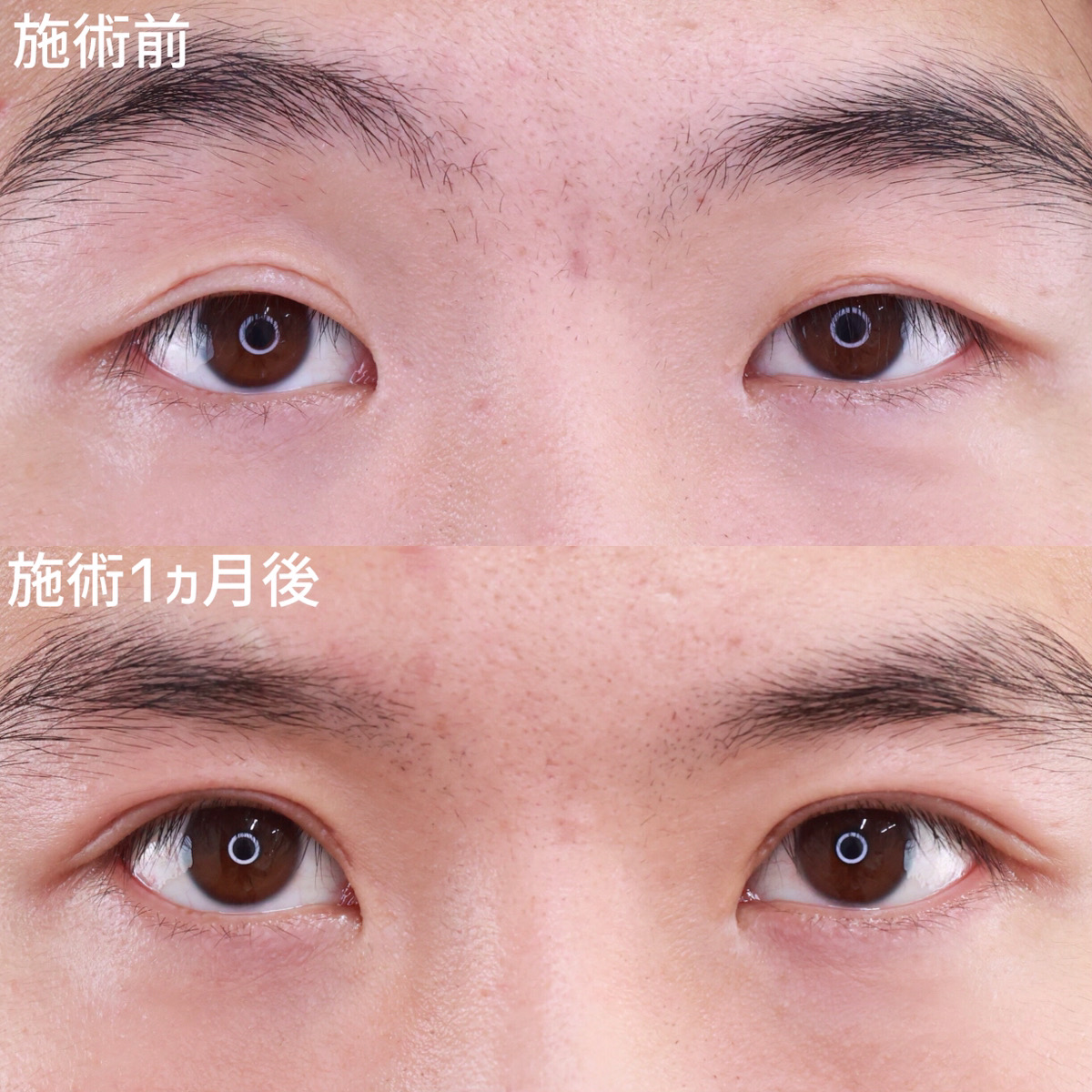 上眼瞼切開術の症例写真 施術前後