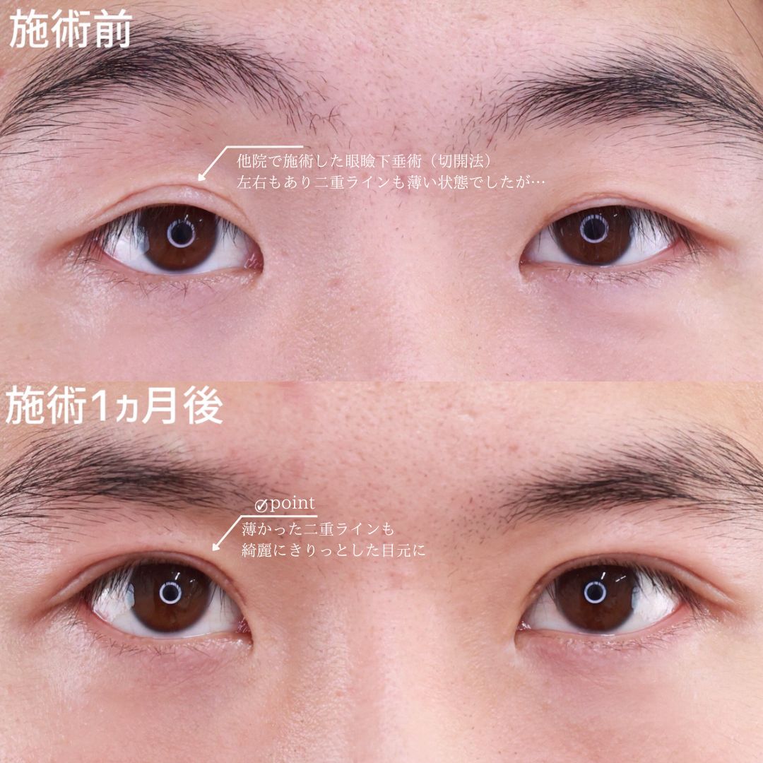 上眼瞼切開術の症例写真 施術前後