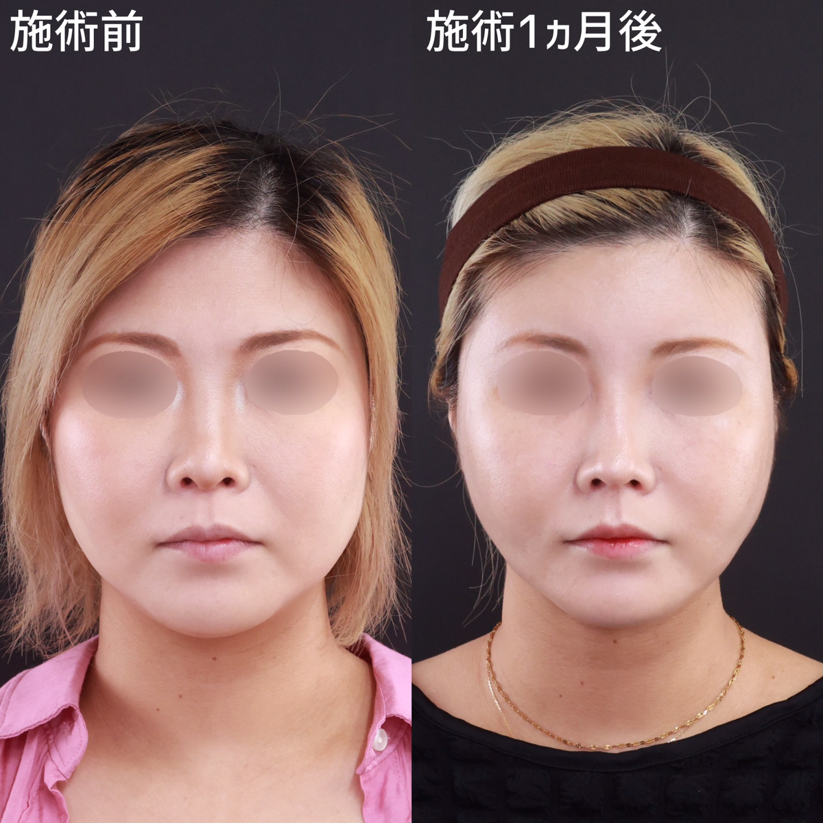 TAC式 ツヤ肌コラーゲンリフト®/顎下の脂肪吸引/鼻尖形成・鼻尖縮小の症例写真 施術前後 