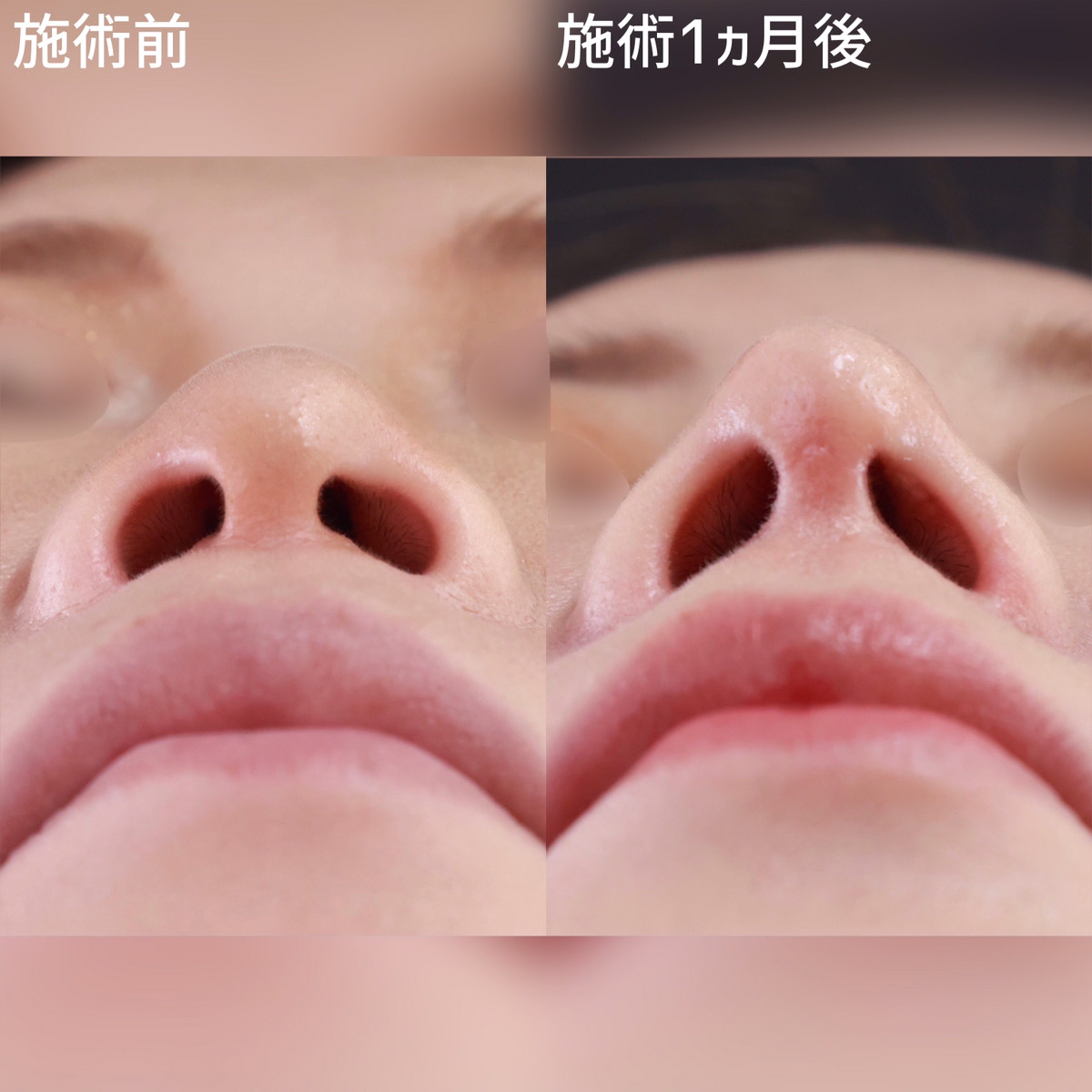 TAC式 ツヤ肌コラーゲンリフト®/顎下の脂肪吸引/鼻尖形成・鼻尖縮小の症例写真 施術前後 