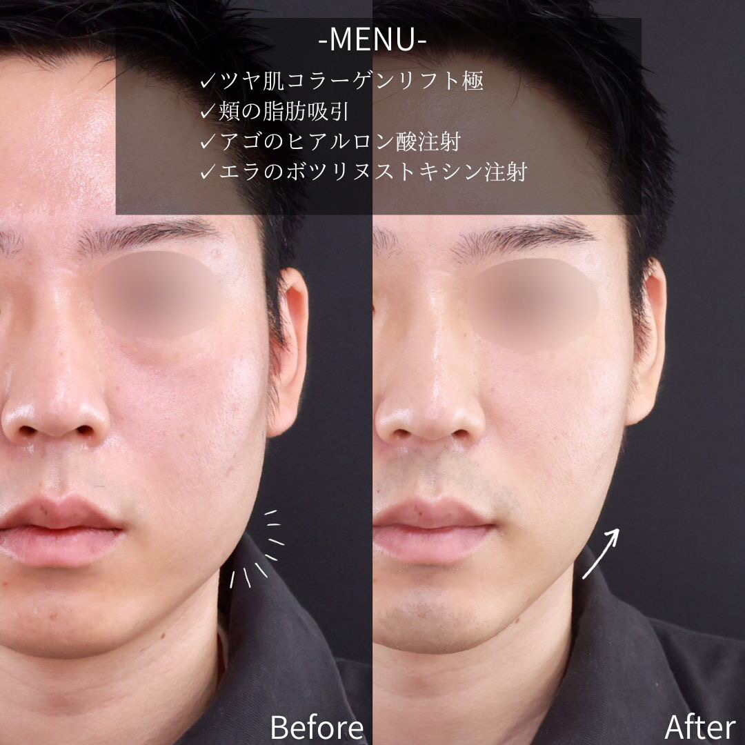 TAC式 ツヤ肌コラーゲンリフト®/顔の脂肪吸引/エラボトックス注射の症例写真 施術前後