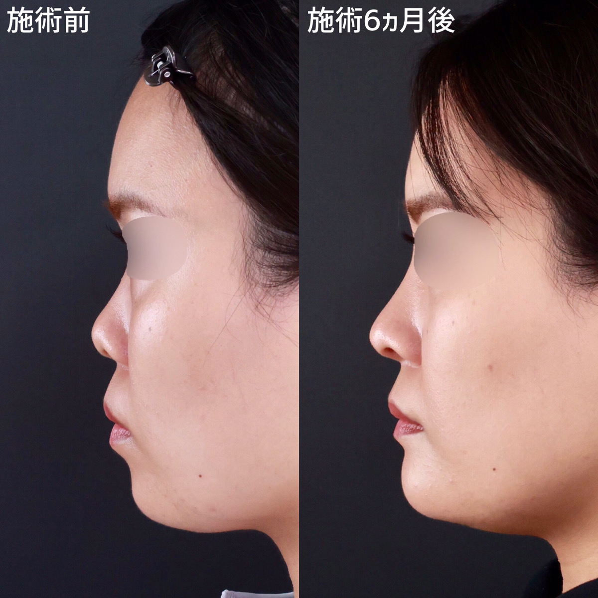 鼻尖形成・鼻尖縮小/鼻中隔延長術/鼻先軟骨移植の症例写真 施術前後