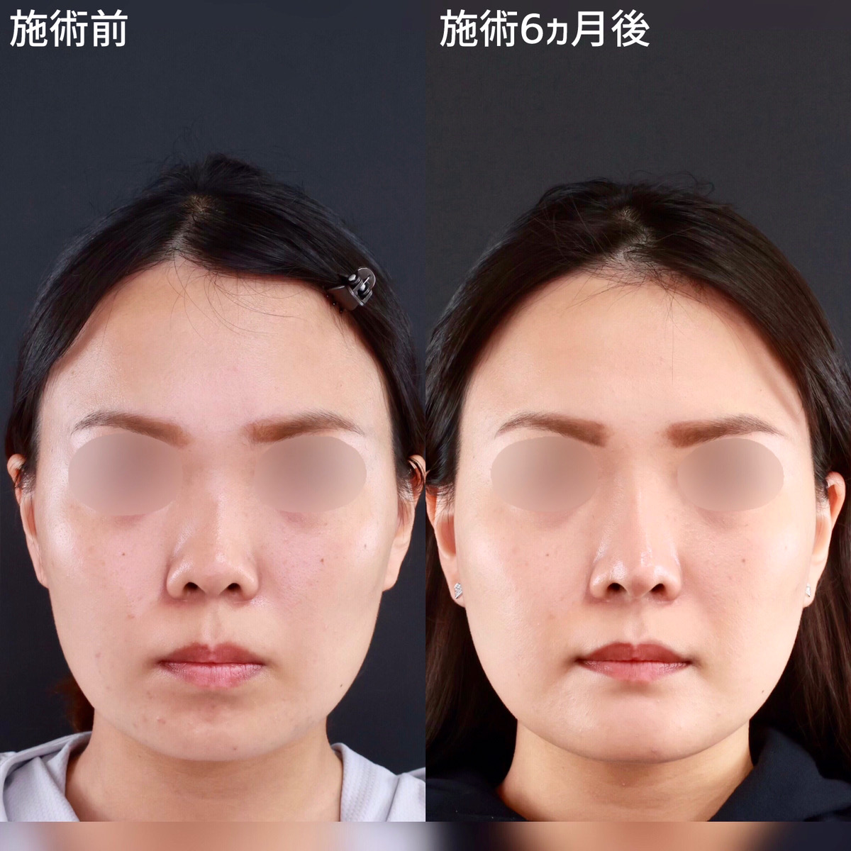 鼻尖形成・鼻尖縮小/鼻中隔延長術/鼻先軟骨移植の症例写真 施術前後
