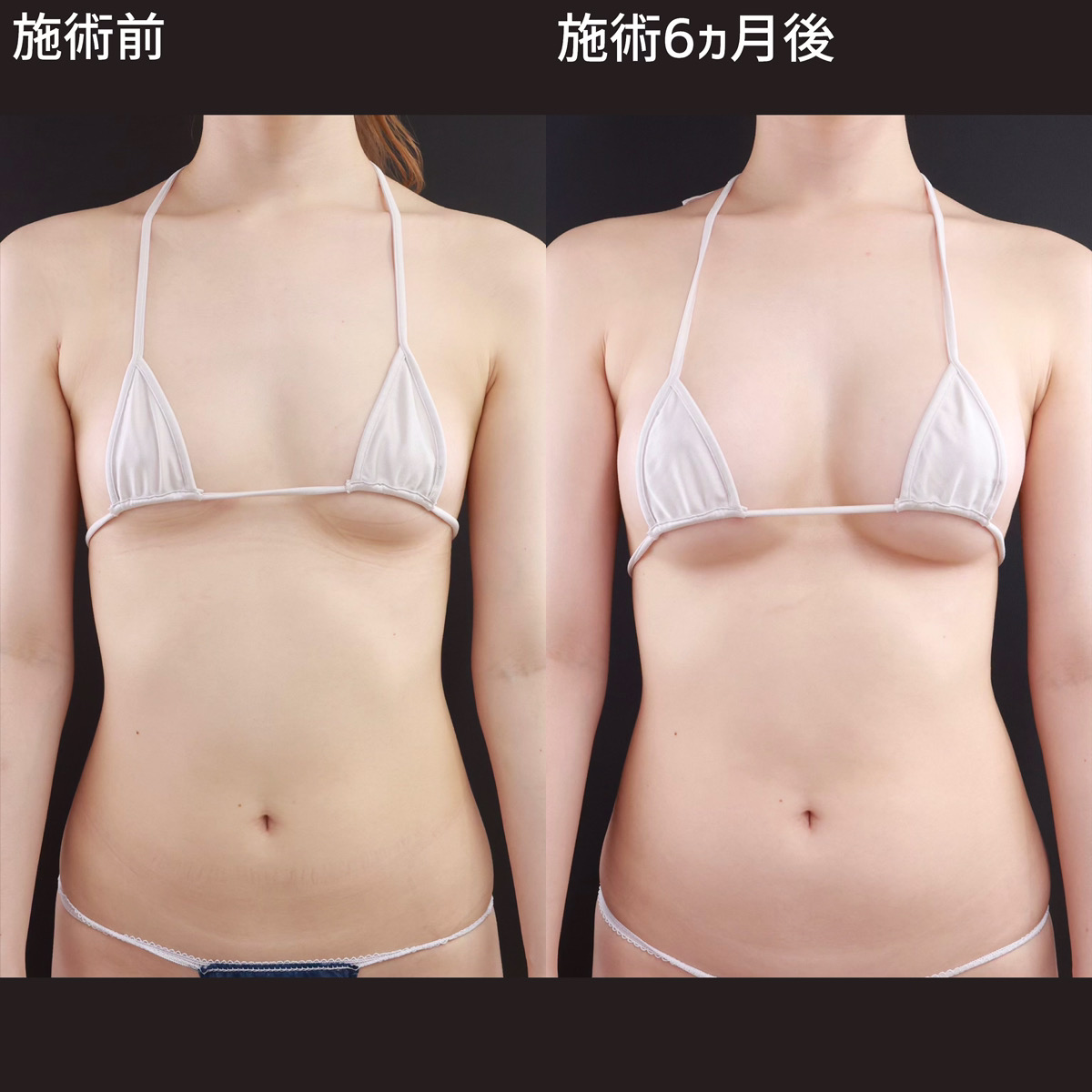 シリコンバッグ豊胸（人工乳腺バッグ）の症例写真 施術前後 