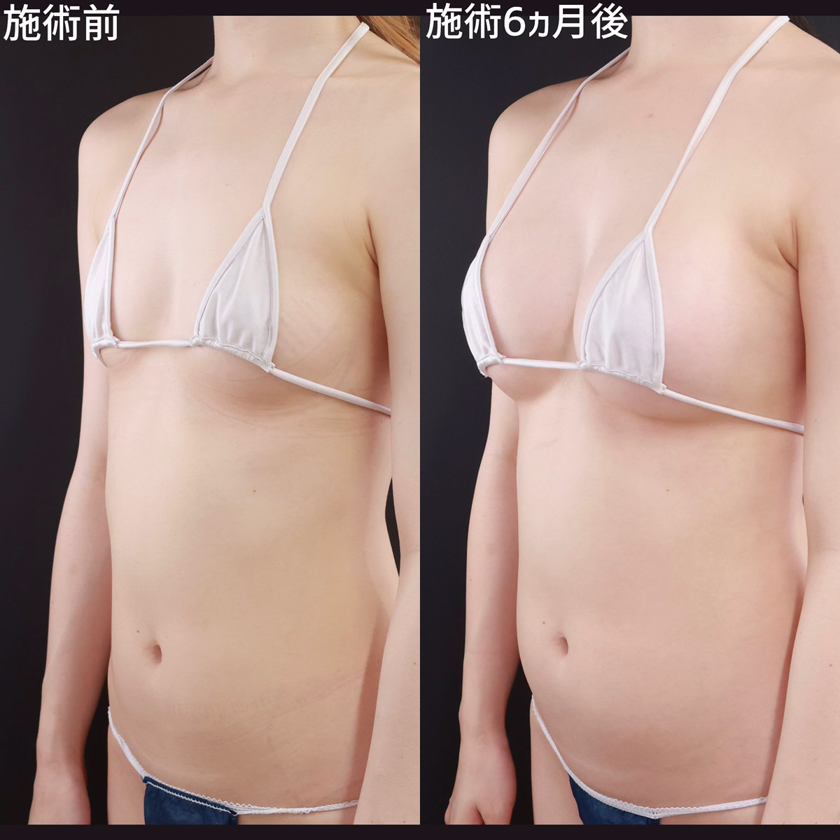 【シリコンバッグ豊胸】理想のふっくらバストへ