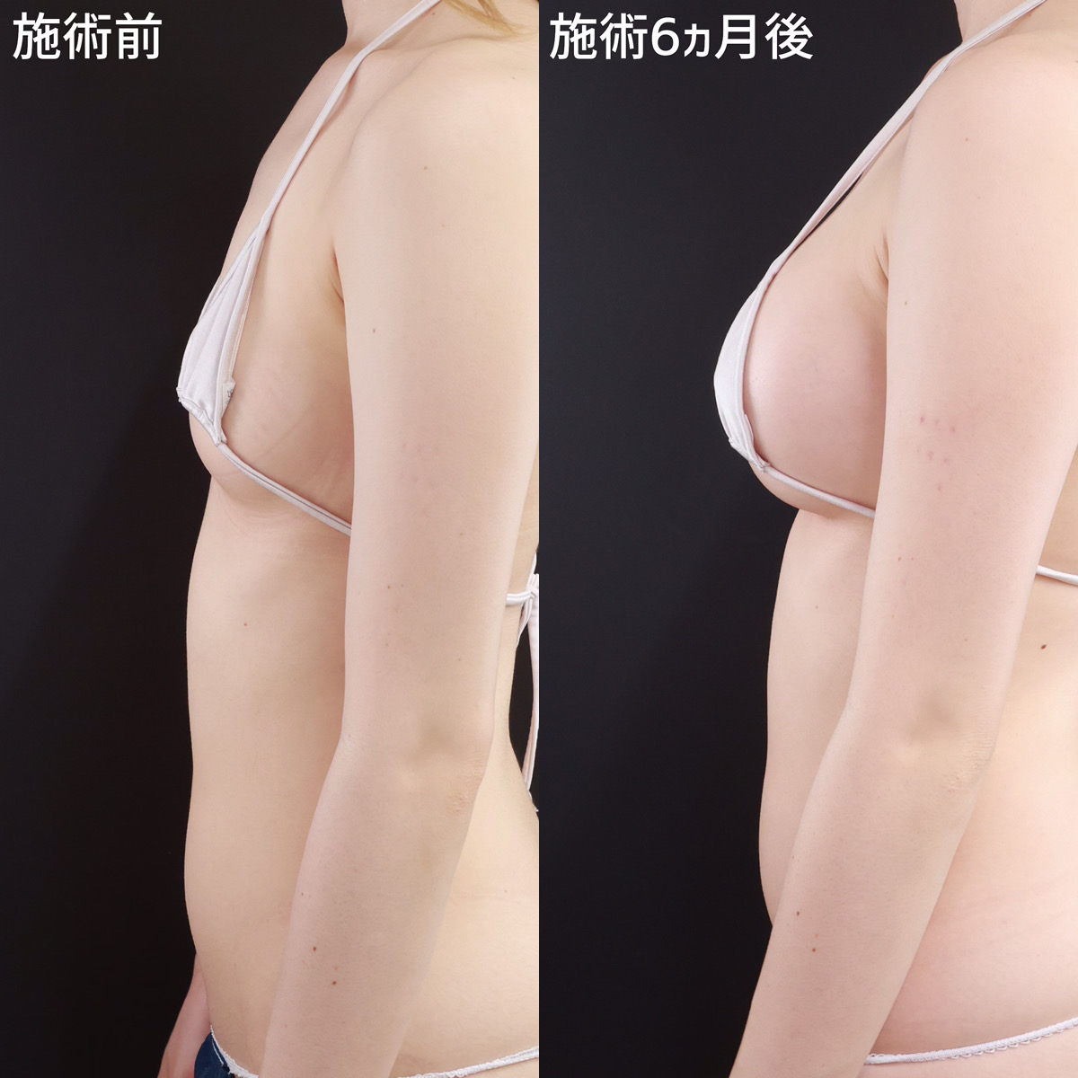 シリコンバッグ豊胸（人工乳腺バッグ）の症例写真 施術前後 