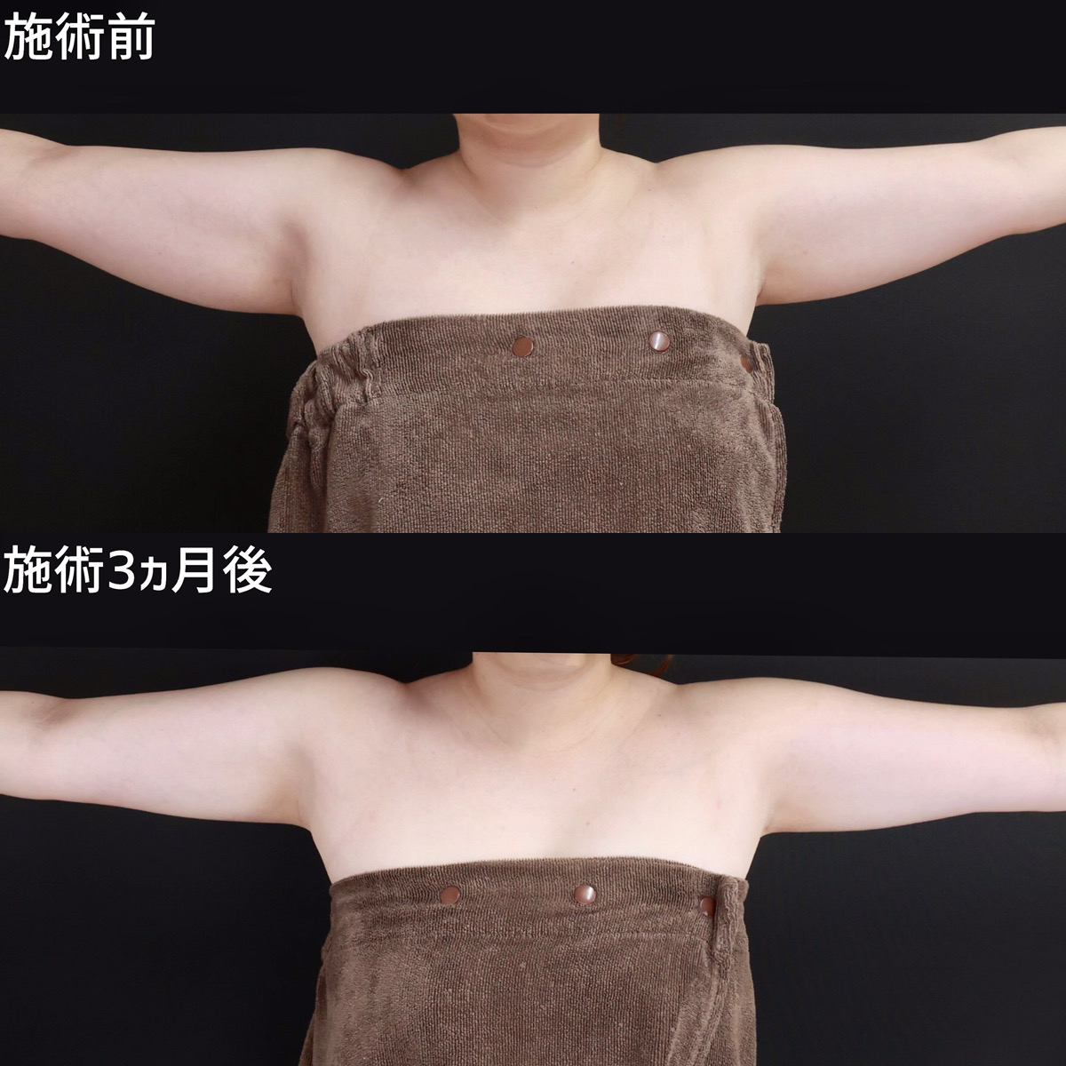 体の脂肪吸引の症例写真 施術前後 