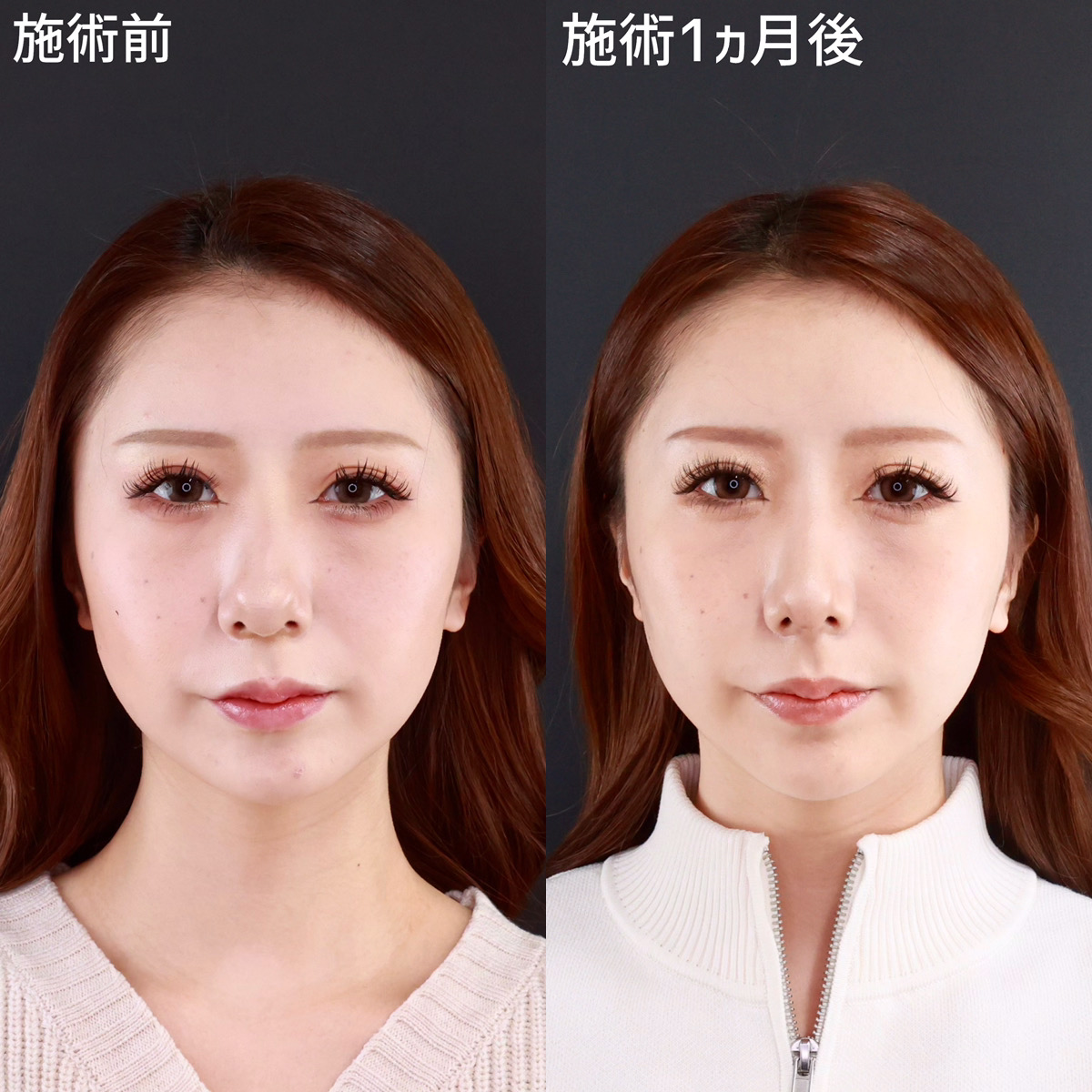 【鼻整形＋小顔整形】わし鼻を改善し、女性らしい柔らかな印象へ