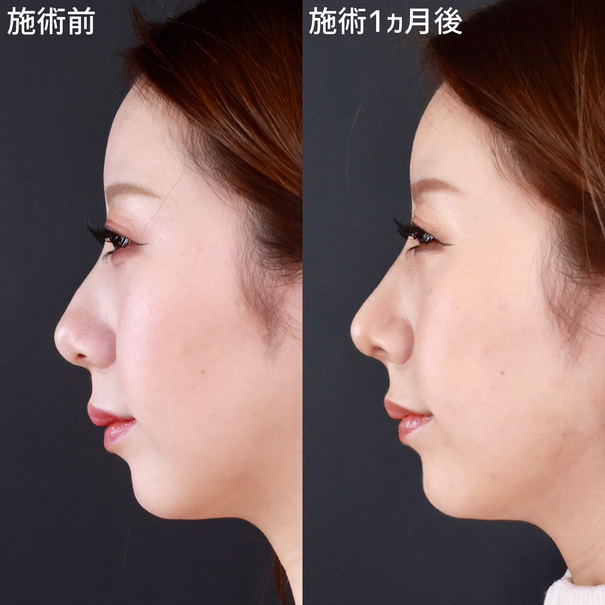 鼻先軟骨移植/鼻尖形成・鼻尖縮小/TAC式 ツヤ肌コラーゲンリフト®の症例写真 施術前後 