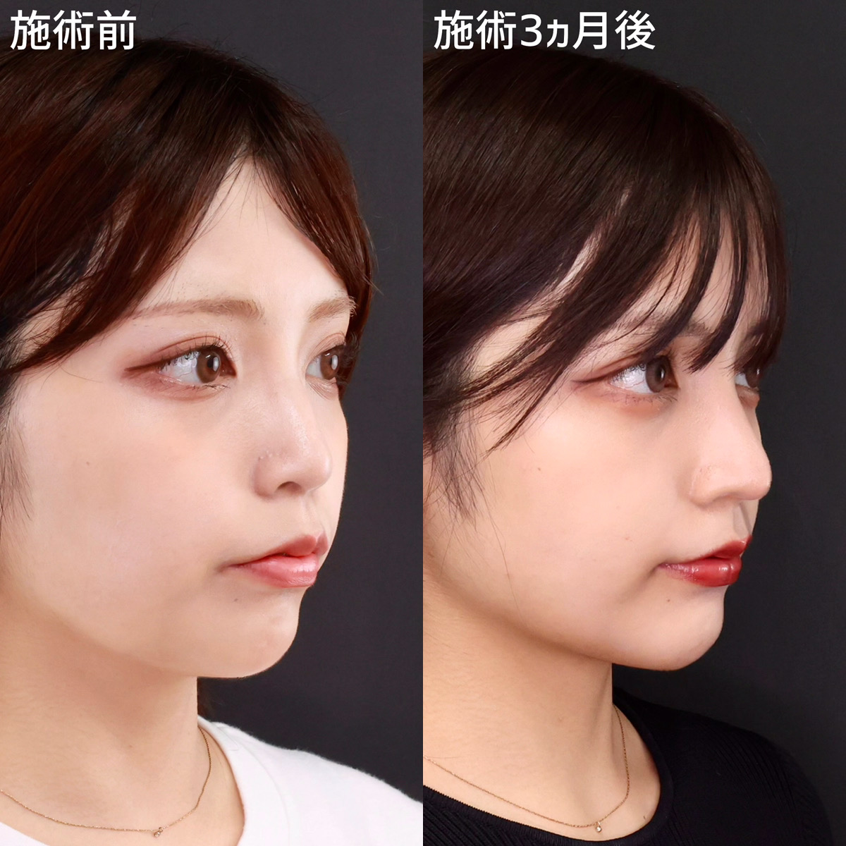 鼻尖形成・鼻尖縮小/鼻中隔延長術/鼻先軟骨移植の症例写真 施術前後