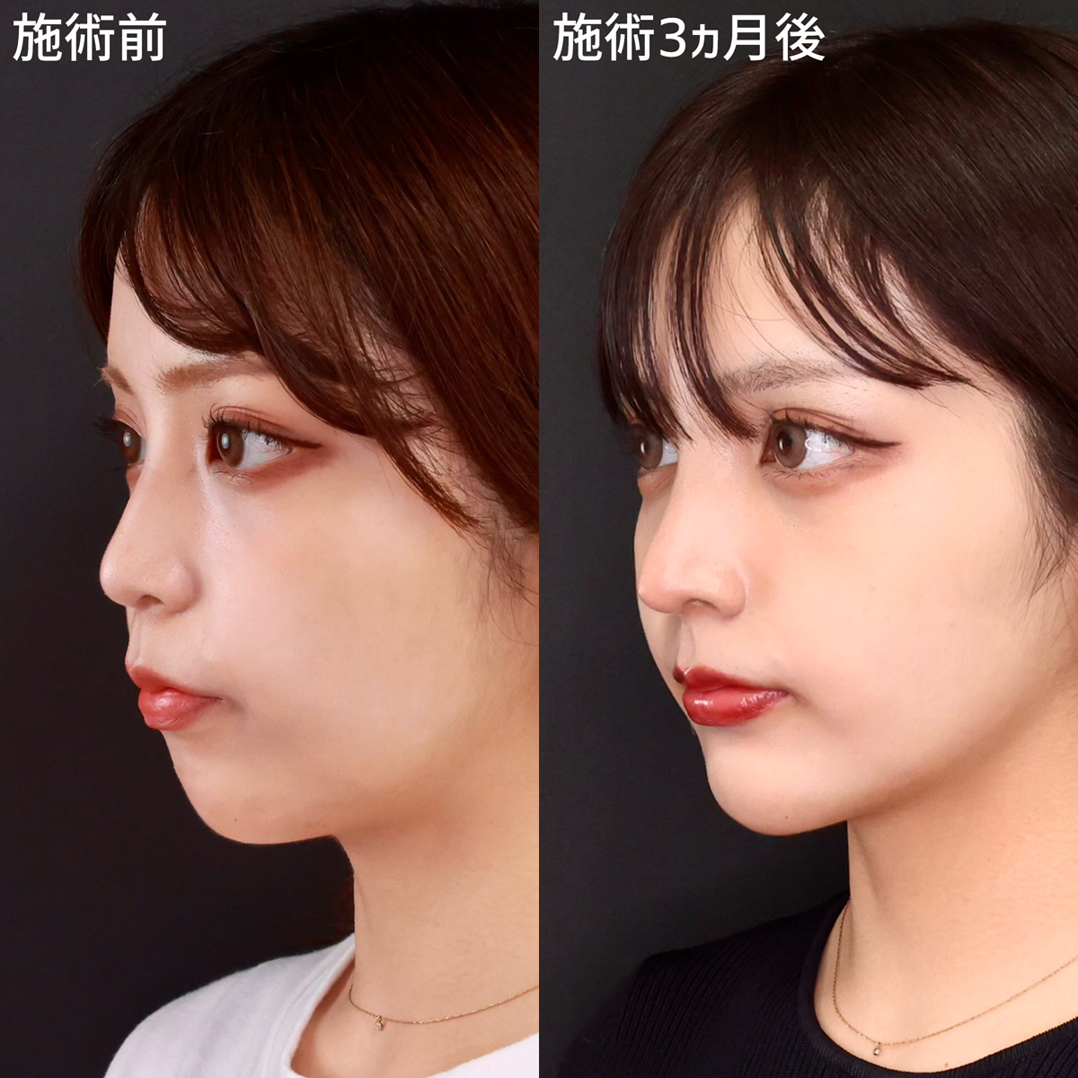 鼻尖形成・鼻尖縮小/鼻中隔延長術/鼻先軟骨移植の症例写真 施術前後