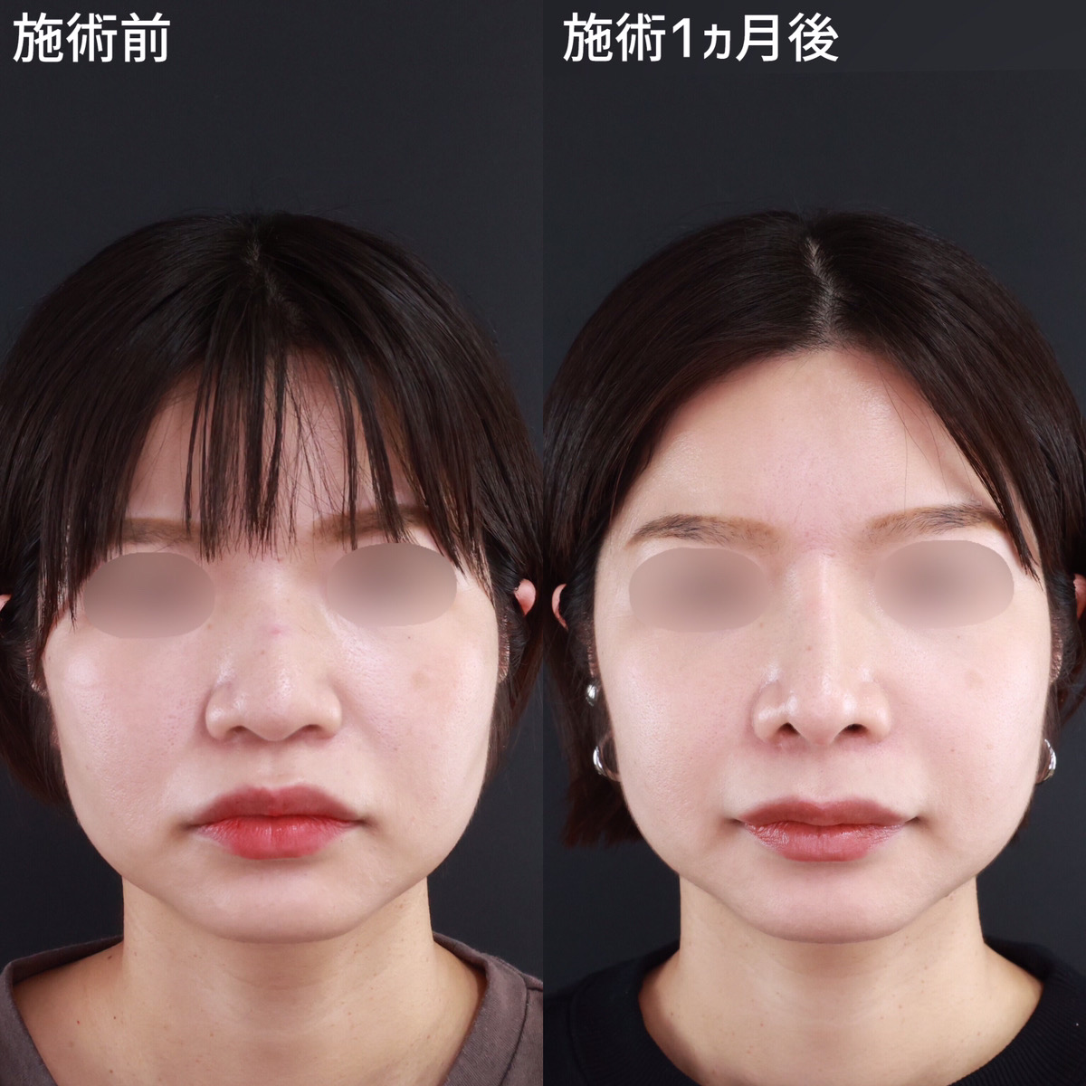 鼻尖形成・鼻尖縮小/鼻先軟骨移植/鼻中隔延長術の症例写真 施術前後 