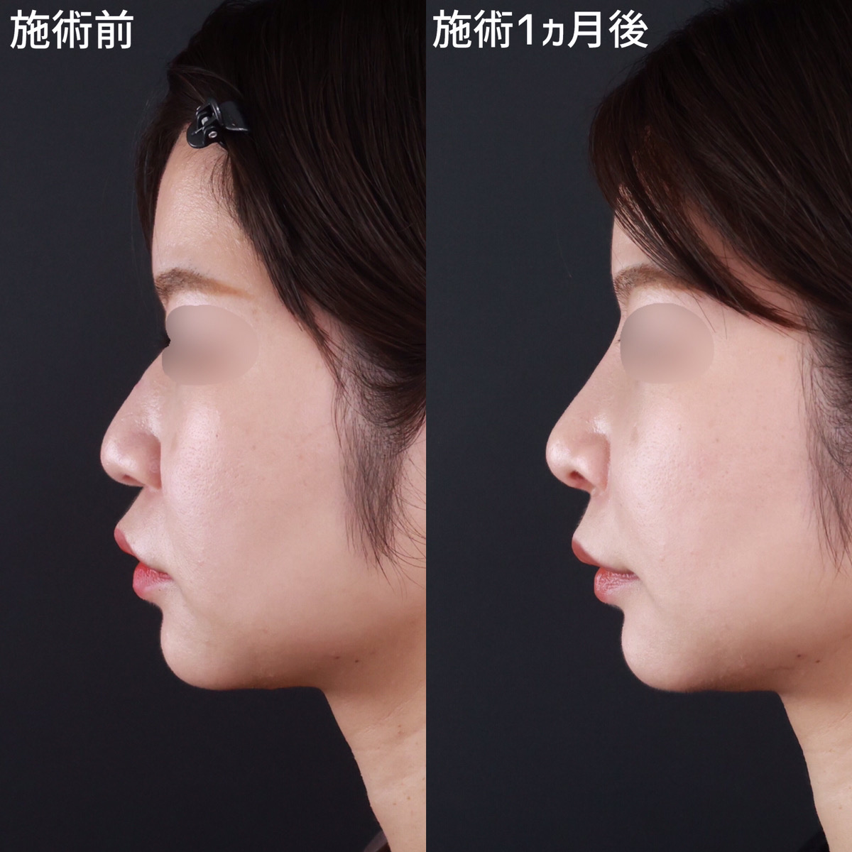 鼻尖形成・鼻尖縮小/鼻先軟骨移植/鼻中隔延長術の症例写真 施術前後 