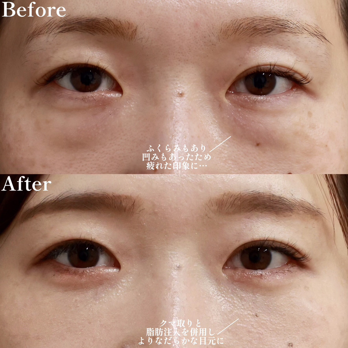 下眼瞼脱脂術(目の下のたるみ取り・目の下の脂肪ふくらみ取り)/顔の脂肪注入(コンデンスリッチフェイス)の症例写真 施術前後