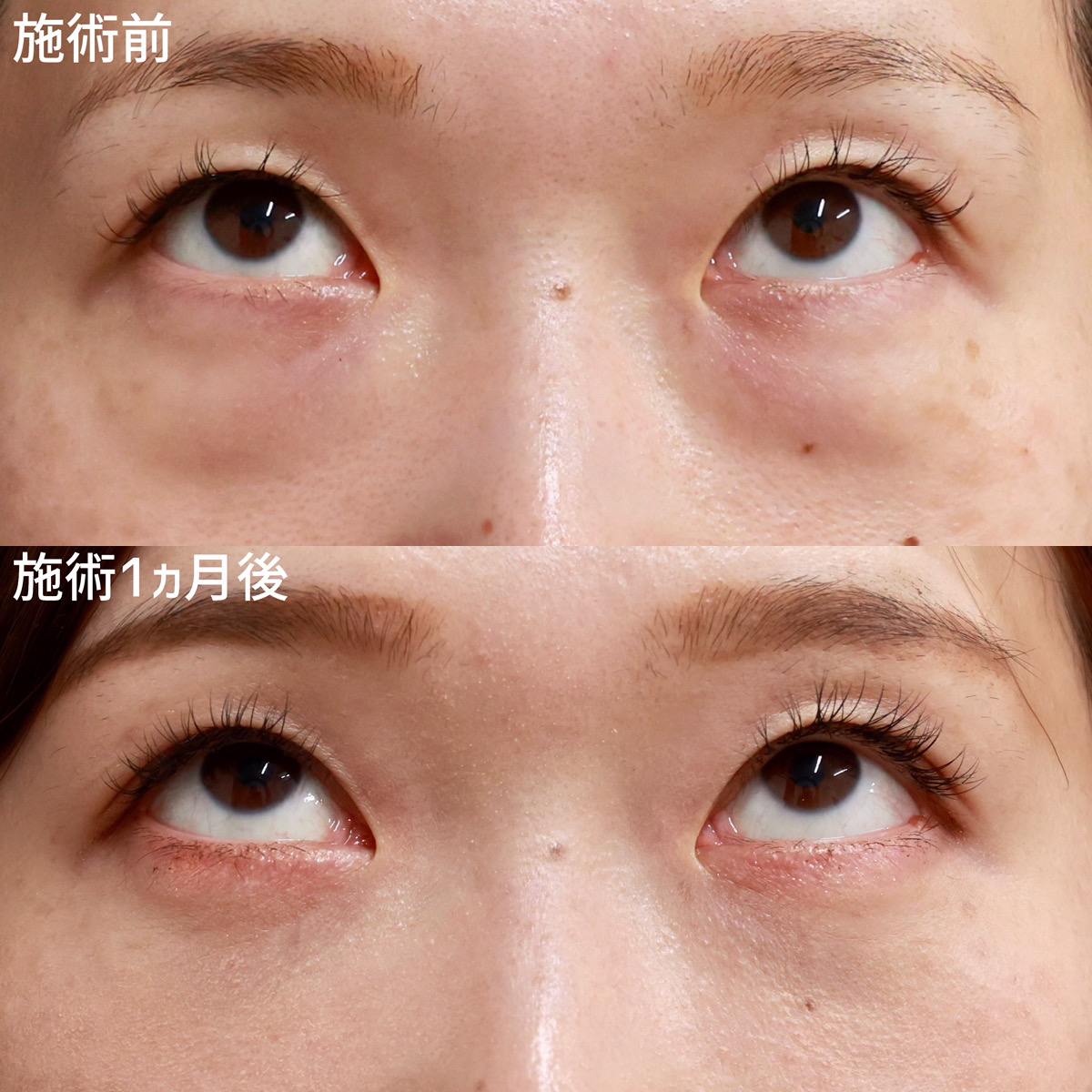 下眼瞼脱脂術(目の下のたるみ取り・目の下の脂肪ふくらみ取り)/顔の脂肪注入(コンデンスリッチフェイス)の症例写真 施術前後