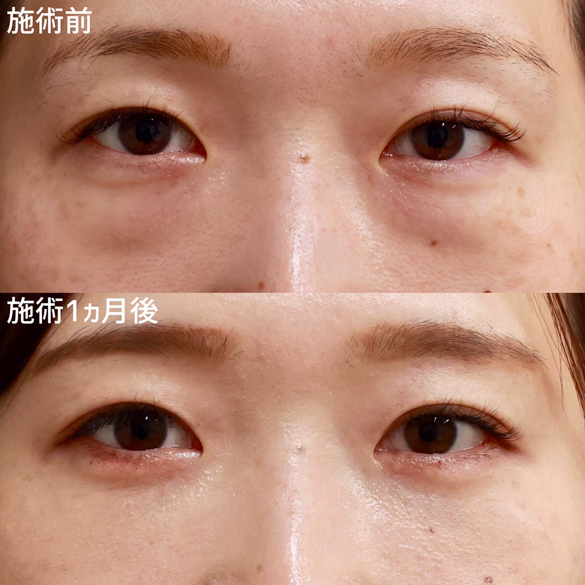 【クマ取り】目元が明るくなり、自信に満ちた目元に