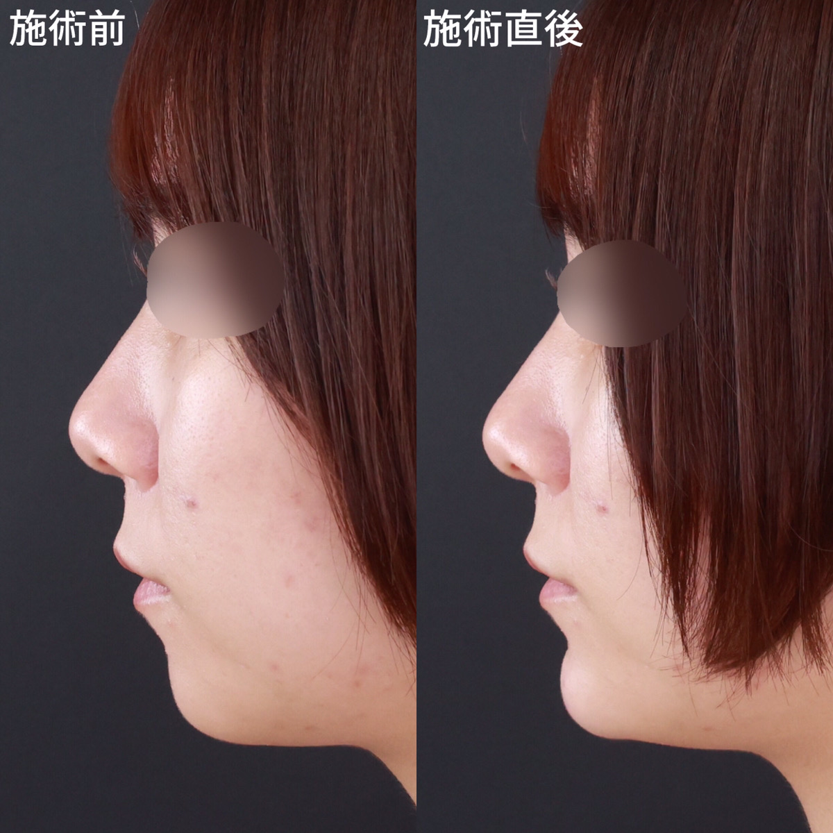 【顎ヒアルロン酸注射】Eラインが整い横顔美人へ