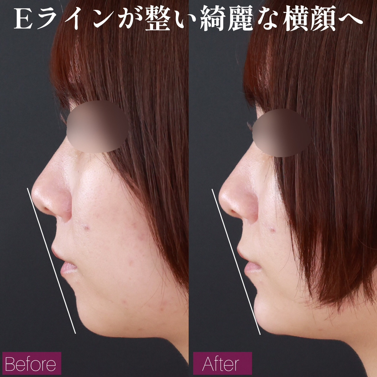 顎のヒアルロン酸注射の症例写真 施術前後 