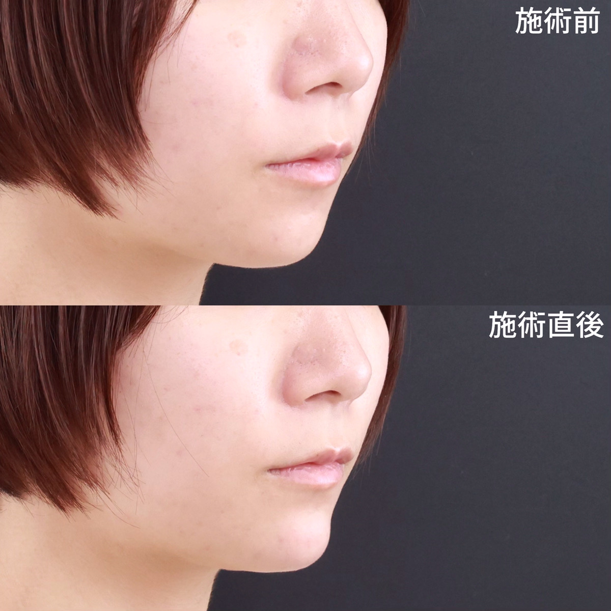 顎のヒアルロン酸注射の症例写真 施術前後 