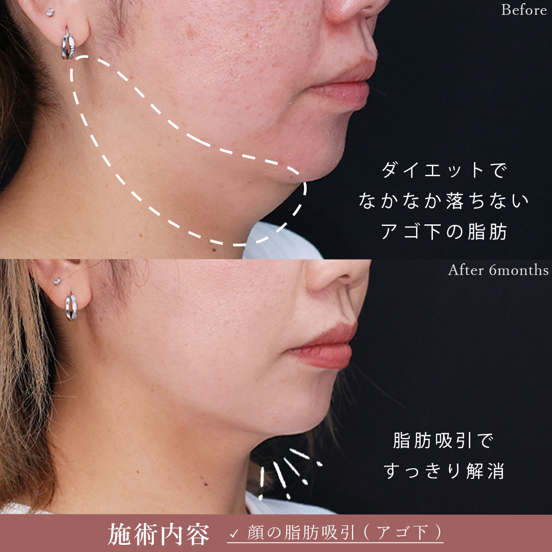 顔の脂肪吸引の症例写真 施術前後