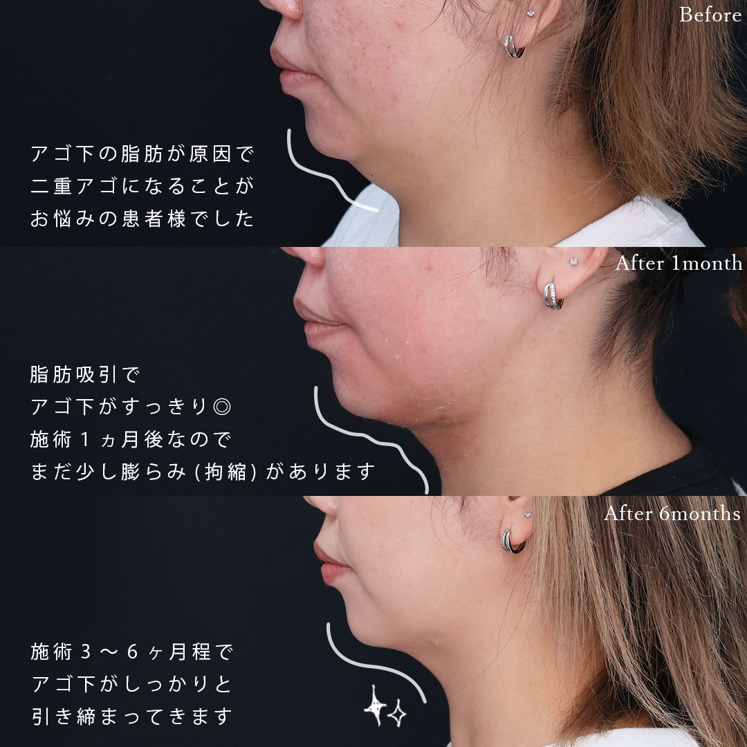 顔の脂肪吸引の症例写真 施術前後