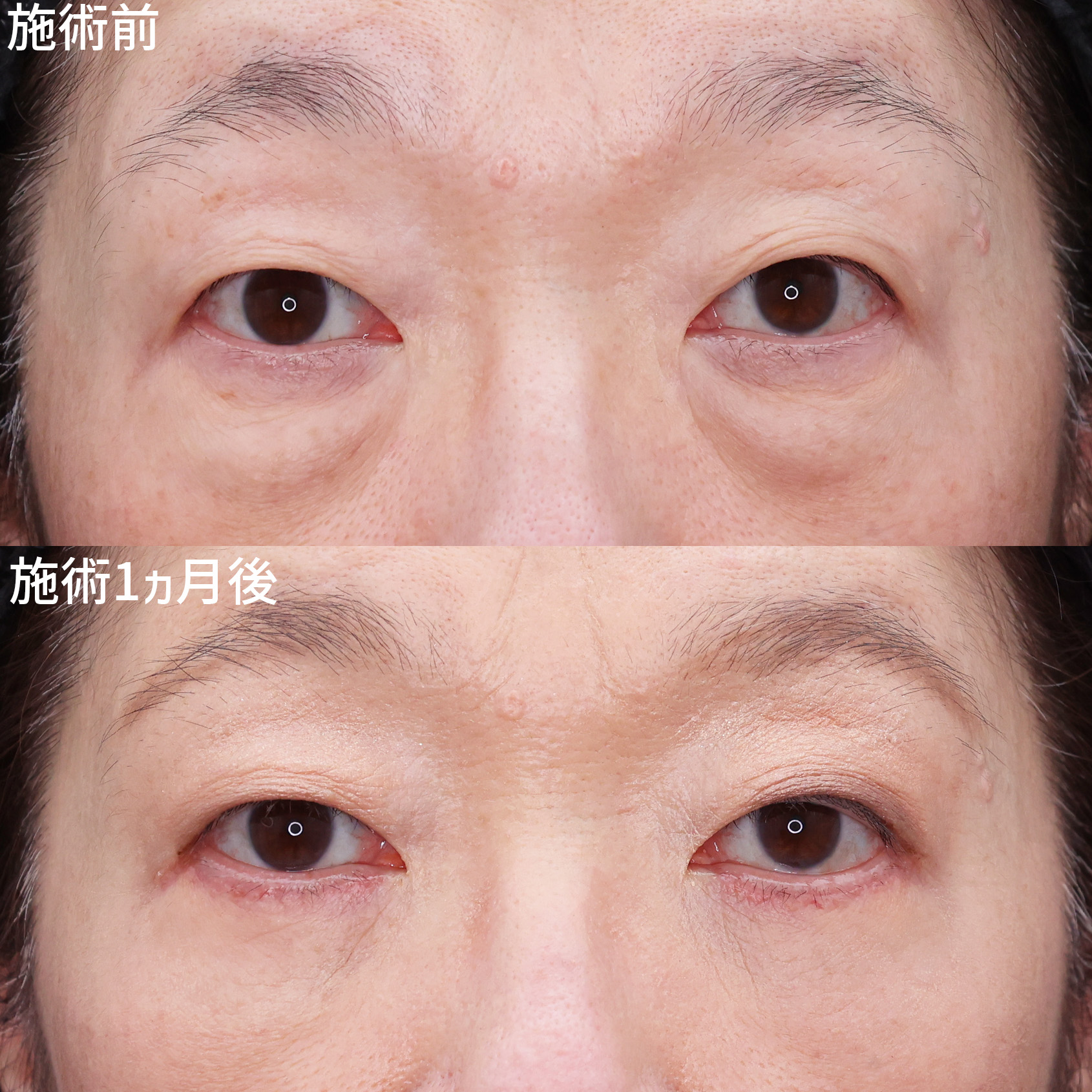 【クマ・たるみ取り】目元の若返りで印象改善！