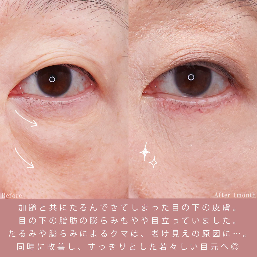 下眼瞼切開術(クマ・たるみとり)/下眼瞼脱脂術(目の下のたるみ取り・目の下の脂肪ふくらみ取り)の症例写真 施術前後