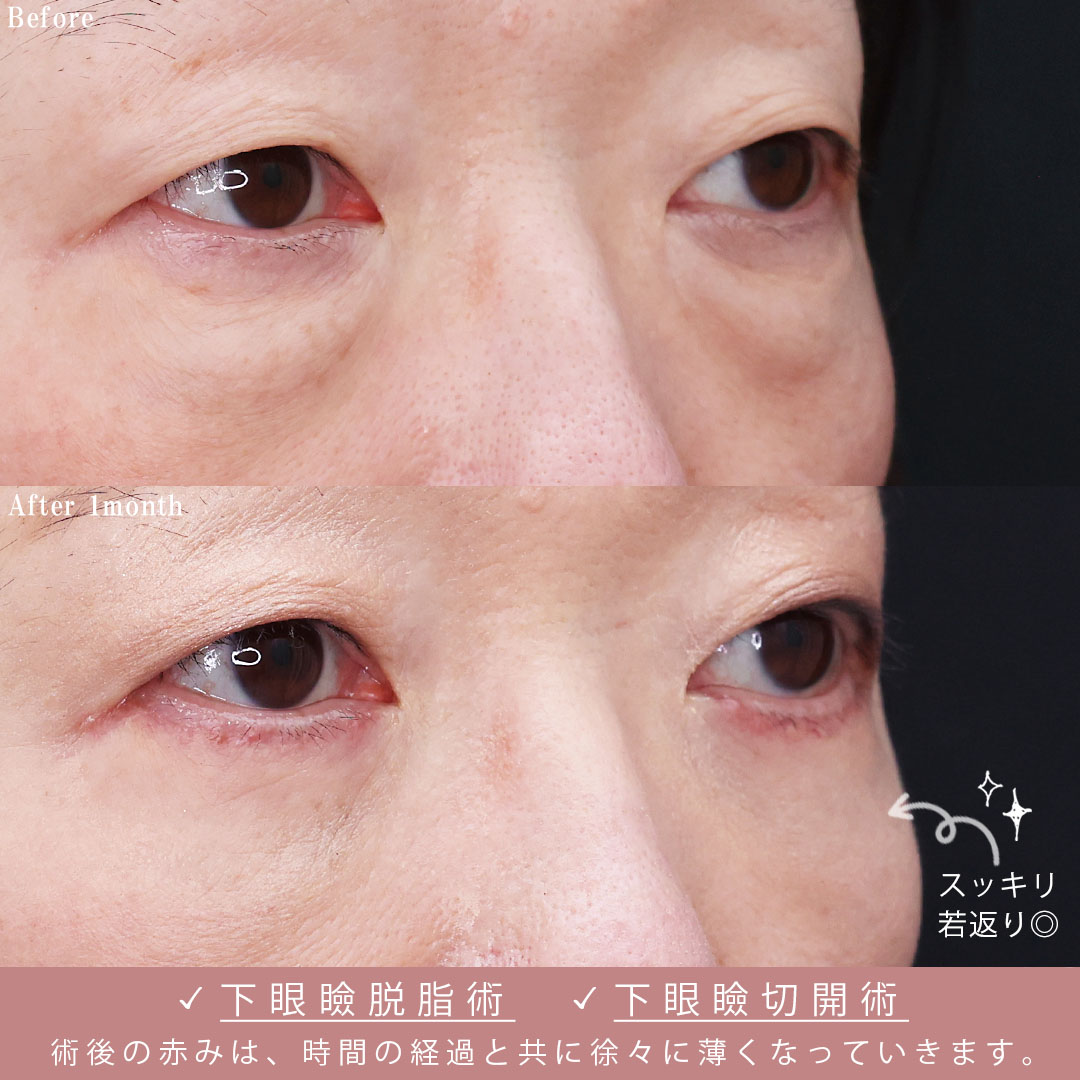 下眼瞼切開術(クマ・たるみとり)/下眼瞼脱脂術(目の下のたるみ取り・目の下の脂肪ふくらみ取り)の症例写真 施術前後