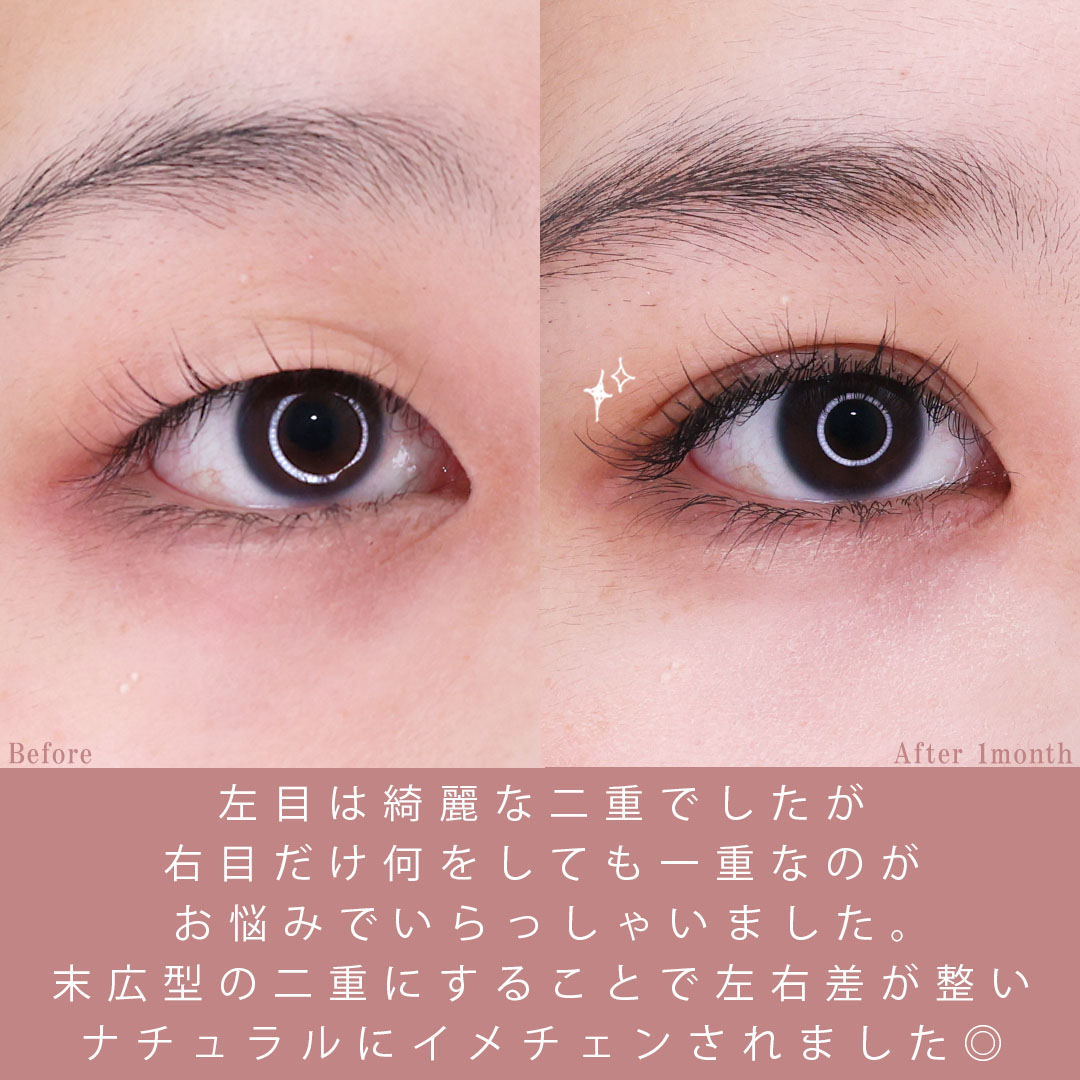 二重埋没法/片目二重術（片目だけ整形したい方）の症例写真 施術前後 