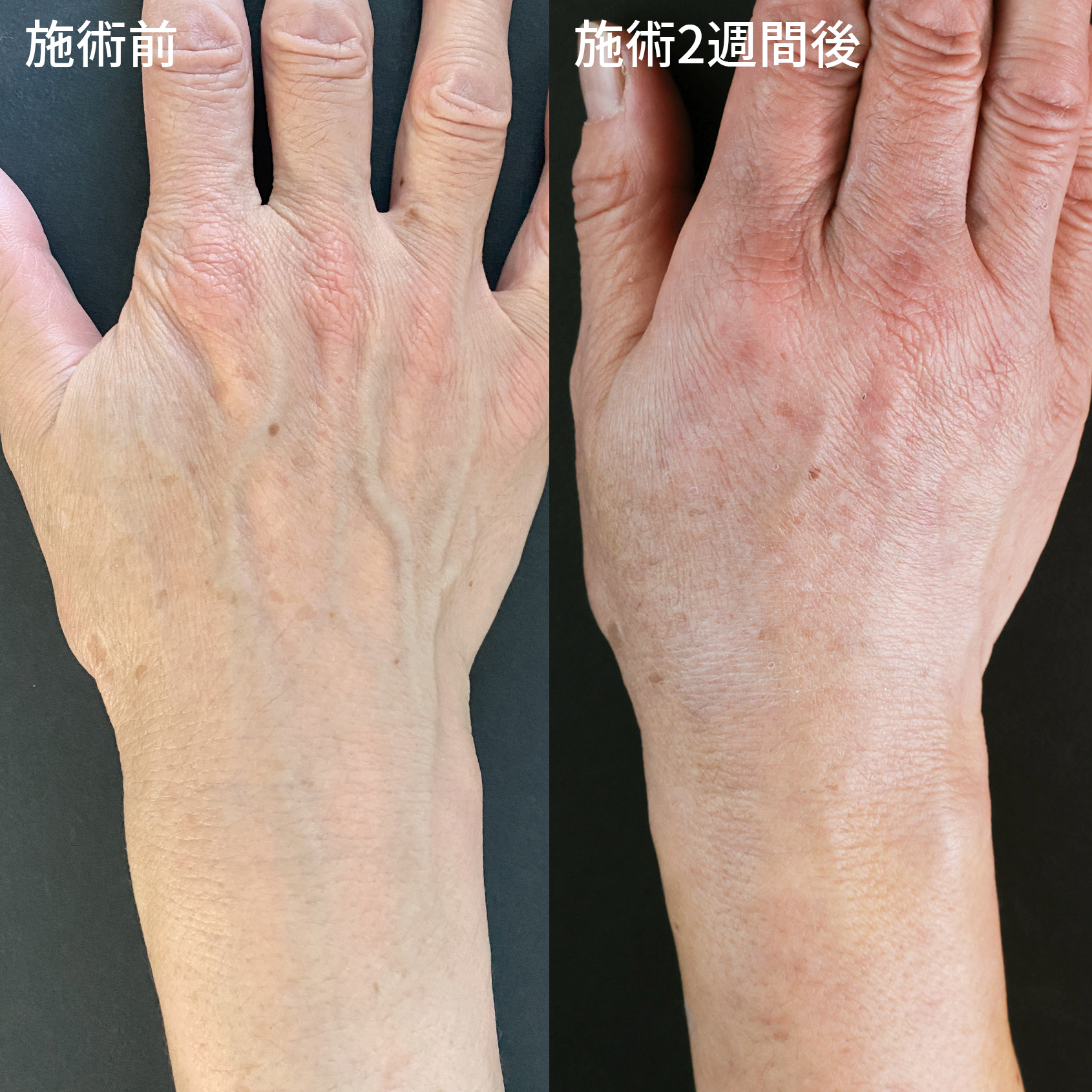 年齢の出やすい手元…【ハンドベイン】で手元の若返り◎